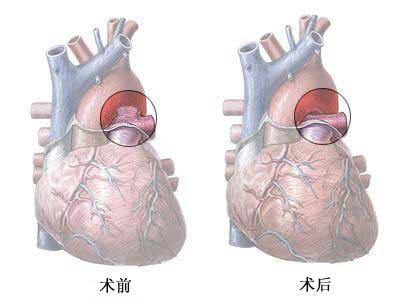 算法创新可能有助于减少侵入性心脏手术