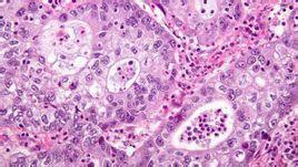 前列腺癌细胞吐出促进肿瘤生长的蛋白质