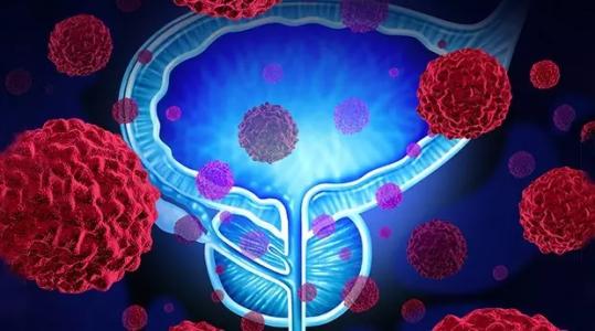 前列腺癌细胞吐出促进肿瘤生长的蛋白质
