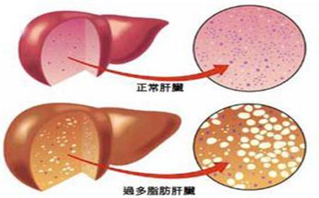 新分子可以帮助对抗2型糖尿病和非酒精性脂肪性肝病