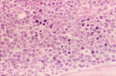 单细胞测序揭示了肺肿瘤中骨髓细胞的景观