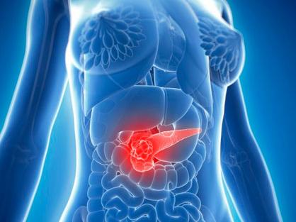 针对LIF介导的旁分泌相互作用进行胰腺癌治疗和监测