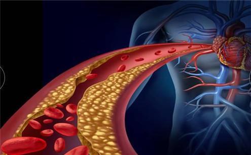 胆固醇转运蛋白促进心血管斑块的积累