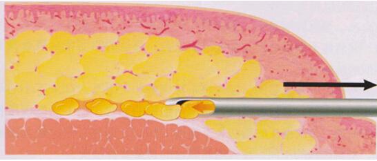 脂肪组织可以帮助癌细胞增殖转移