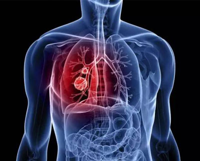 在肺癌中操纵肿瘤抑制蛋白Rb揭示了可能的药物靶标