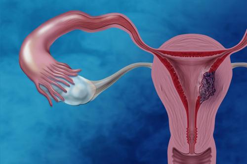 研究发现有望为治疗2型子宫内膜癌提供新的视角