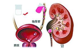 科学家发现第一个涉及下尿路梗阻的基因