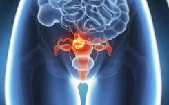 研究人员确定了34种与卵巢癌风险增加相关的基因