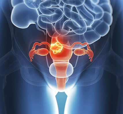 液体活检可以指向最佳的卵巢癌治疗