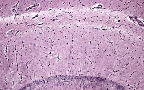 新一类小胶质细胞在神经退行性病变中的作用
