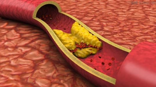 与新代谢组学研究中的动脉硬化有关的常见食物
