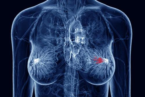 海洋天然化合物可能是三阴性乳腺癌的潜在治疗方法