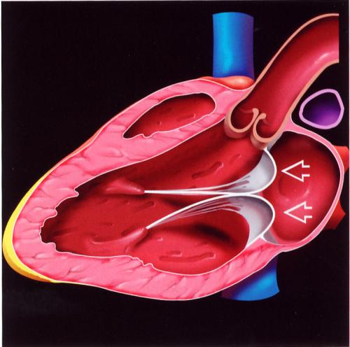 由纤毛缺损引起的二尖瓣脱垂
