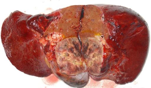 用有机体研究肝脏肿瘤的形成