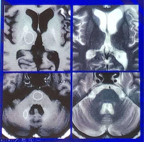 科学家研究没有患癌症的Cockayne综合征患者