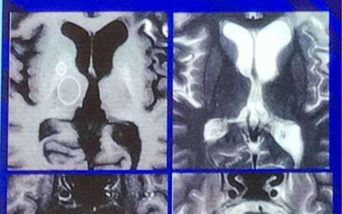 科学家研究没有患癌症的Cockayne综合征患者