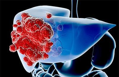 无线电波治疗阻断肝癌细胞的生长