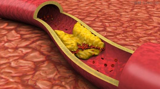 什么原因导致动脉硬化及其解决方法