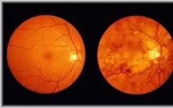 免疫系统在视网膜变性中的作用是疾病依赖性
