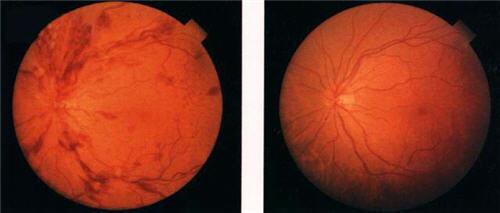 补体系统显示去除色素性视网膜炎中的死细胞与之前的研究相矛盾