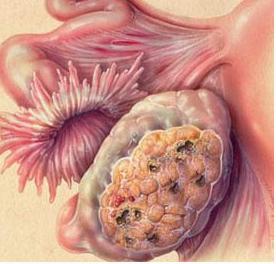 新型卵巢癌诊断可以消除​​探索性手术