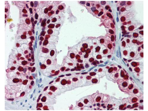 FOXA1突变改变了开创性活动分化和前列腺癌表型