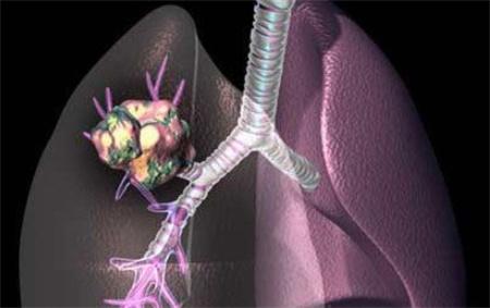 糖醛酸途径中的代谢中间体损害肺癌转移