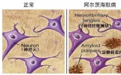 阿尔茨海默氏症的进展可能会影响新发现的淀粉样蛋白-Tau Link