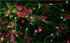 ALS神经元中的蛋白质团块为新疗法提供了潜在的靶标