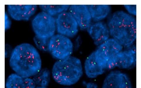 分子印迹纳米粒对HER2对肿瘤细胞的抑制作用