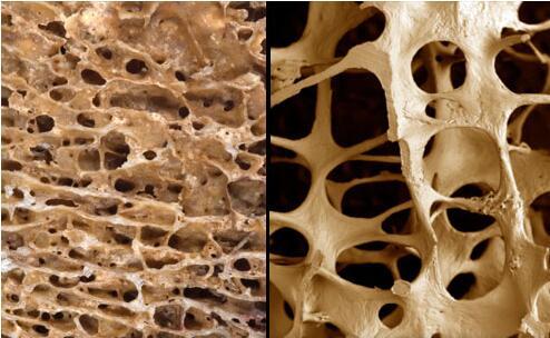 新的骨质疏松症治疗对骨组织的双重影响