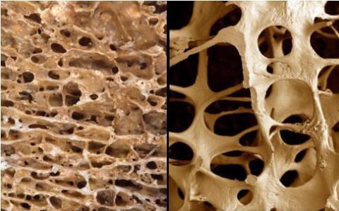 新的骨质疏松症治疗对骨组织的双重影响
