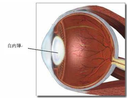 白内障手术是将已经混浊的晶状体去掉 换上一枚人工晶状体