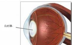 白内障手术是将已经混浊的晶状体去掉 换上一枚人工晶状体