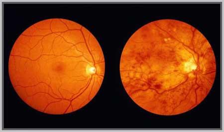 一种旧药物发现了抗视网膜新生血管的新目的