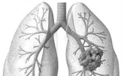 高剂量利福平在肺结核中的疗效和安全性