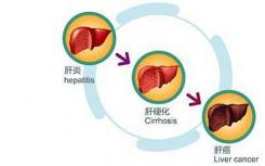 酒精性肝病取代丙型肝炎感染是肝移植的主要原因