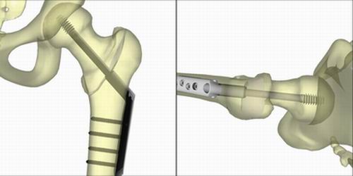 与可调节胃束带相比 Roux-en-Y手术与更多的非椎骨骨折相关