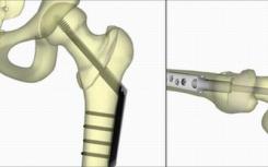 与可调节胃束带相比 Roux-en-Y手术与更多的非椎骨骨折相关