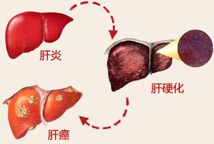 未感染的患者是否应该接受丙型肝炎感染的肝脏以减少等待时间