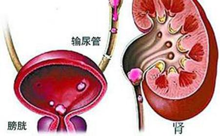 新发现可以改善肾结石疾病的诊断和早期筛查