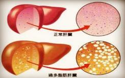 高脂肪肝指数与结直肠腺瘤有关