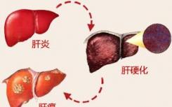 未感染的患者是否应该接受丙型肝炎感染的肝脏以减少等待时间