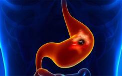 医学专家表示 80%的胃癌早期都可以防治