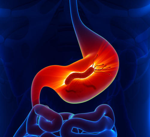 胃食管反流是一种多发病 在我国每10个老人当中 就会有1个