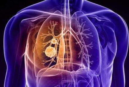 肺癌晚期患者还可以吃银杏蒸鸭 可以达到利水消肿 补血补气作用
