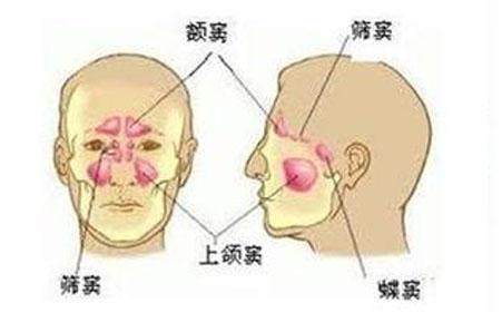 老年患者的独特慢性鼻窦炎形式