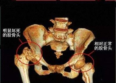 人工髋关节置换术后的康复训练总体上应注重科学性 个体化