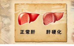 副肝硬化可降低乙型肝炎患者的HCC风险