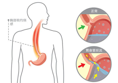 用于检测Barrett食管的可吞咽装置接受FDA 510（k）许可